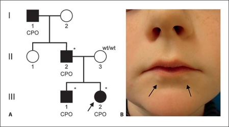 File:Identification of Van Der Woude syndrome by lesions on lower lips.jpg