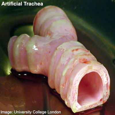 File:Stem cell artificial trachea and bronchi.jpg