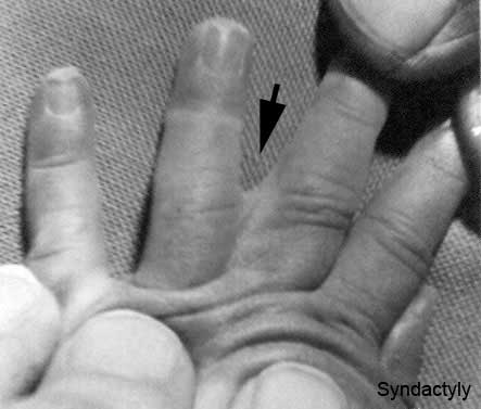 File:Syndactyly.jpg