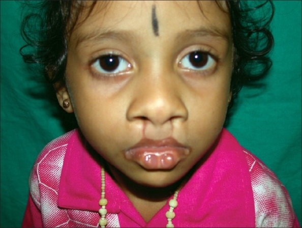 File:Van der Woude syndrome with lower lip pits.jpg
