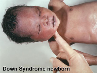 File:Trisomy 21 newborn.jpg