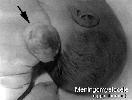 File:Neural tube defect meningomyelocele.jpg