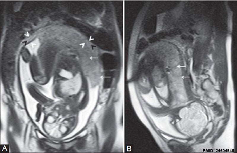 File:Placenta MRI 01.jpg