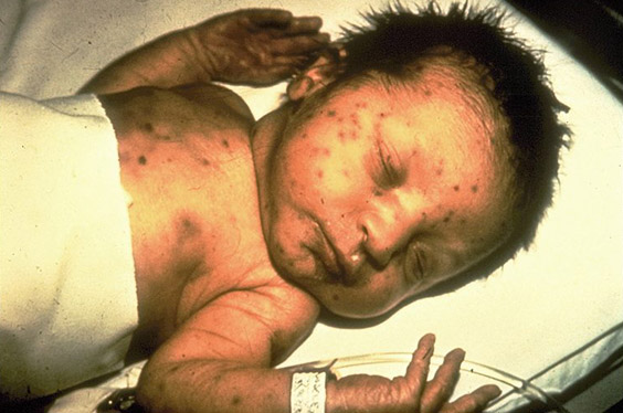 File:Infant rubella virus.jpg