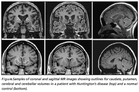 File:Huntington Disease patient and control MRI.gif
