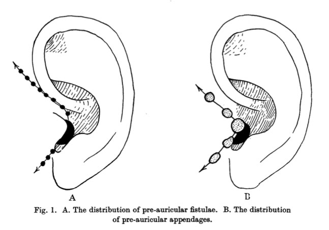 Pre-auricular fistulae and appendage locations.jpg