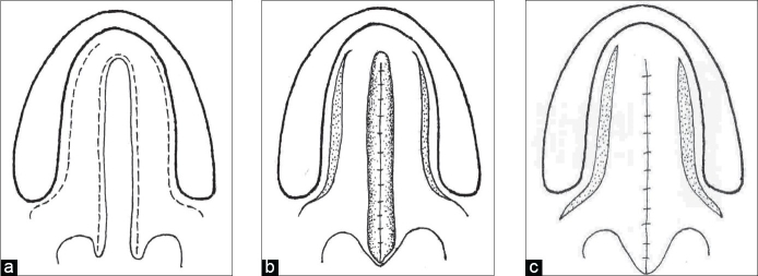 File:Line diagram of von Langenbeck palatoplasty for an isolated complete cleft palate.jpg