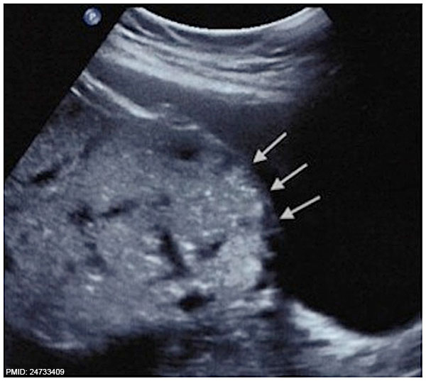 File:Placenta accreta ultrasound bladder wall interface.jpg