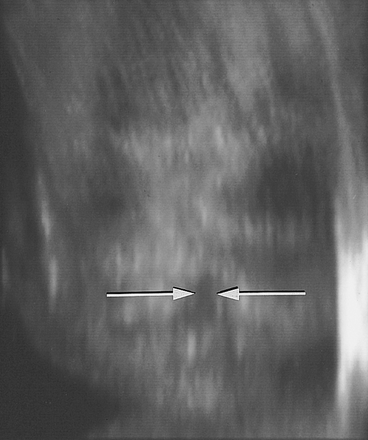 File:Figure 1. Fetal Lip and Primary Palate Three dimensional versus Two dimensional US.gif