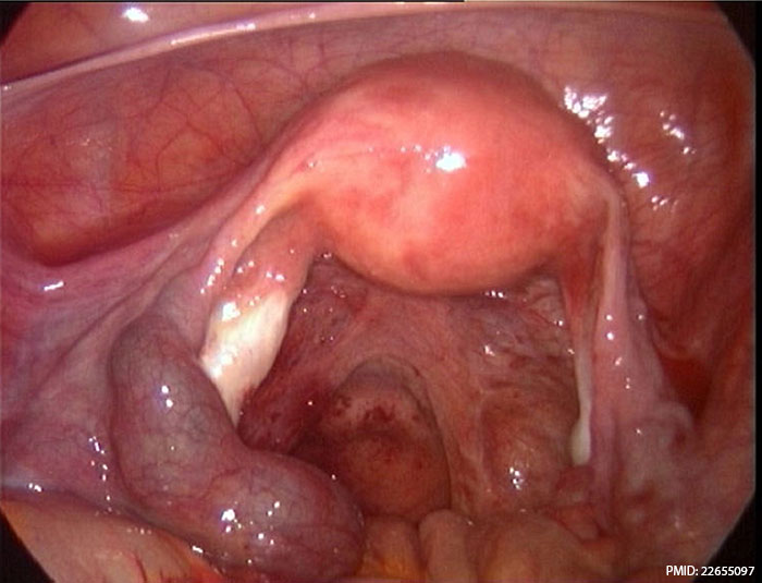 File:Ectopic molar pregnancy 01.jpg