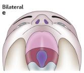 Type Bilateral cleft palate.jpg