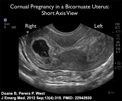 File:Bicornuate uterus ectopic movie icon.jpg