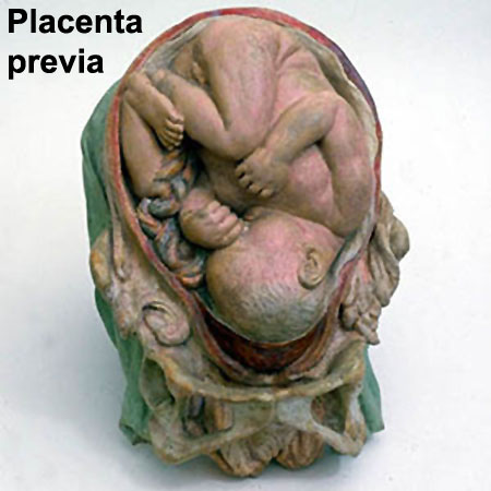 File:Galletti1770 placenta previa.jpg