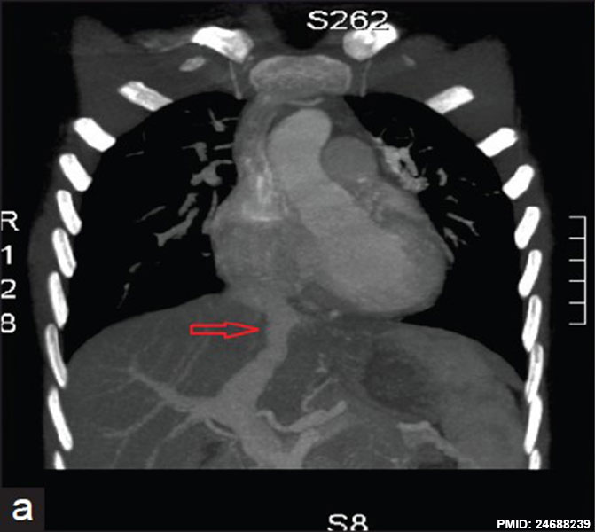 File:Postnatal persistant ductus venosus ultrasound 02.jpg