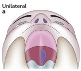 Type Unilateral Cleft Palate.jpg