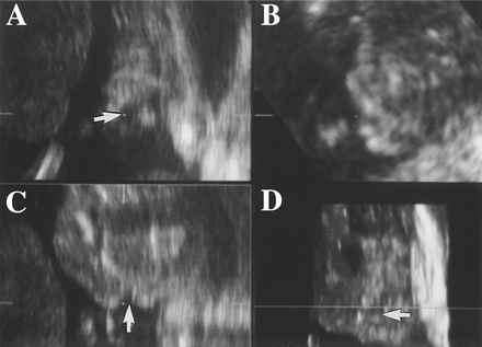 File:Figure 2. Fetal Lip and Primary Palate Three dimensional versus Two dimensional US.gif