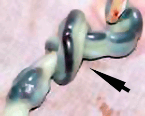 File:Placental cord knot.png