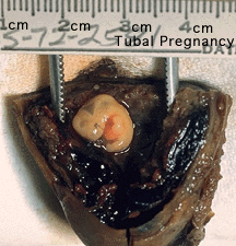 File:Tubal pregnancy.gif