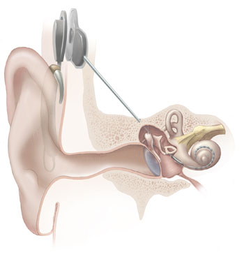 File:Cochlear implant.jpg