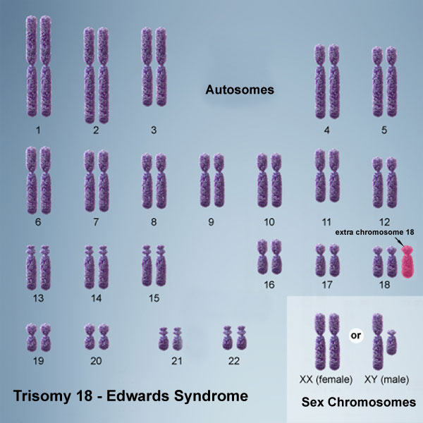 File:Chromosome- trisomy 18.jpg
