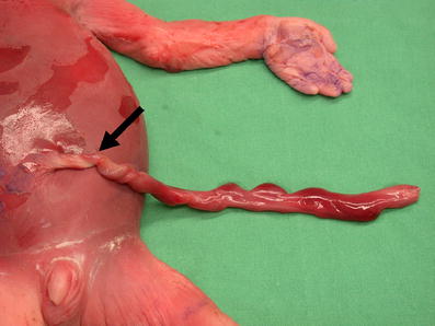 File:Placenta- umbilical cord torsion.jpg