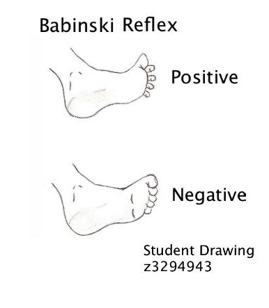 File:The Babinski Reflex.jpg