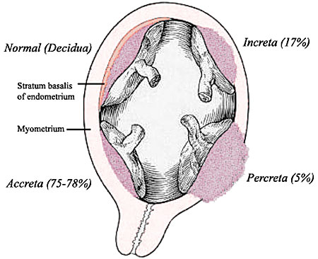 File:Placenta abnormalities.jpg