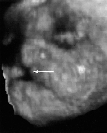 File:Figure 3. Fetal Lip and Primary Palate Three dimensional versus Two-dimensional US.gif