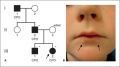 Identification of Van Der Woude syndrome by lesions on lower lips.jpg