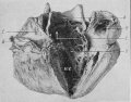 Fig. 31 Persistent truncus arteriosus