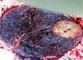 Placental chorioangioma