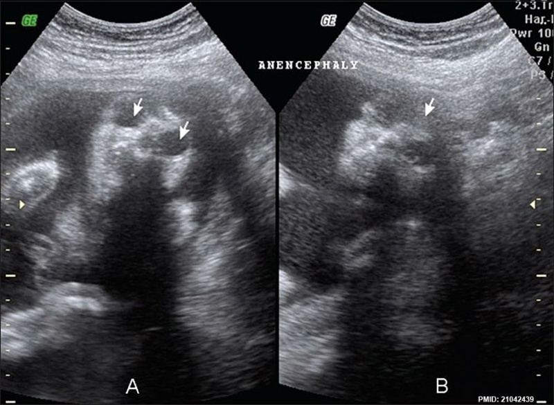 File:Anencephaly ultrasound.jpg