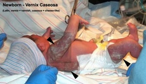 Newborn vernix caseosa