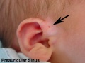 Preauricular sinus