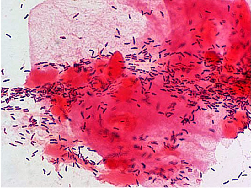 File:Bacteria - gram-stained vaginal smear 07.jpg