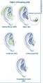 Behind-the-ear (BTE), in-the-ear (ITE), in-the-canal (ITC), and completely-in-canal (CIC) hearing aids