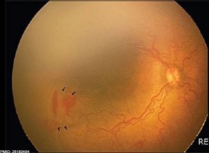 Retinopathy of prematurity in the right eye