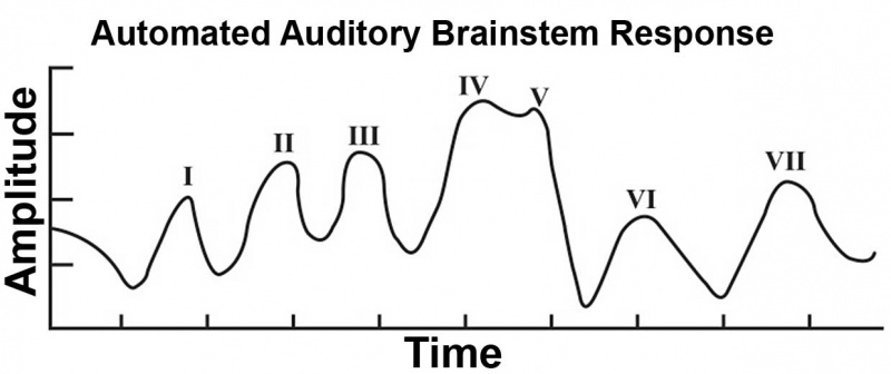 Automated Auditory Brainstem Response