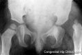 Xray congenital dislocation hip