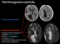 Fig 15. Observable radiographic features in Hemimegalencephaly Z5093005 is this video the original source?