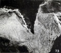Fig. 73. Nodular fibrosis of the amnion. No. 868. Xl-35.