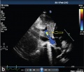 Postnatal persistant ductus venosus ultrasound 03.jpg