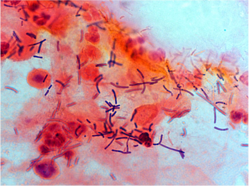 File:Bacteria - gram-stained vaginal smear 04.jpg