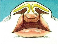 Bilateral Cleft Lip With Nasal Deformity.jpg