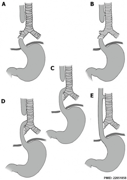 File:Classification of Oesophageal atresia.jpg
