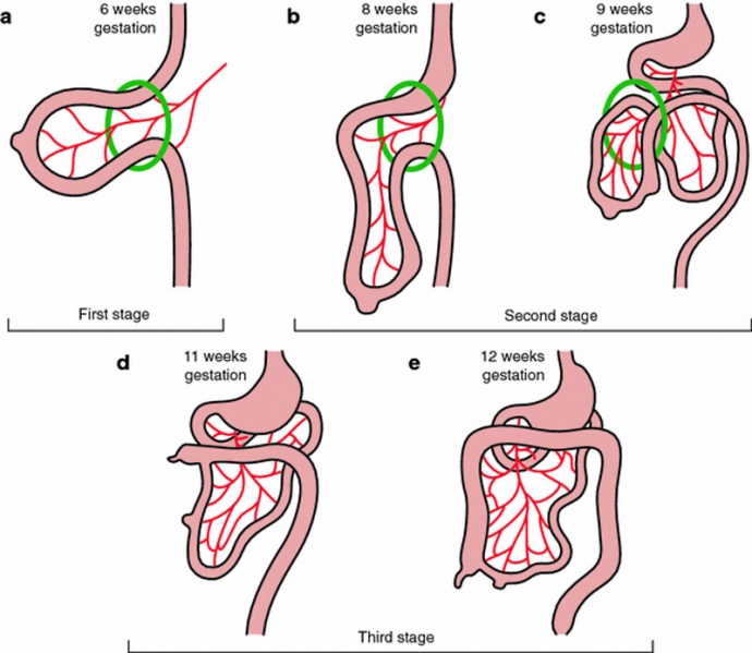File:Normal intestinal rotation cartoon.jpg
