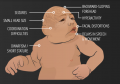 Fig 16. Possible clinical features of Microcephaly in a newborn Z5093005 ref copyright OK, but file naming?