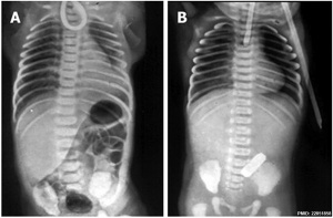 Oesophageal atresia x-ray 01.jpg