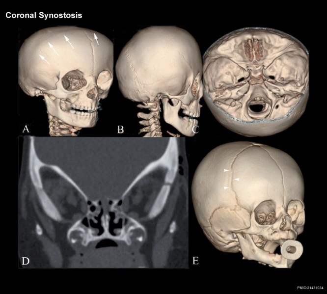 File:Skull CT abnormal 02.jpg