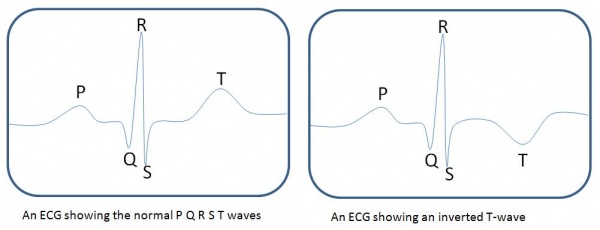 Schematic ECG normal and inverted T-wave.jpg